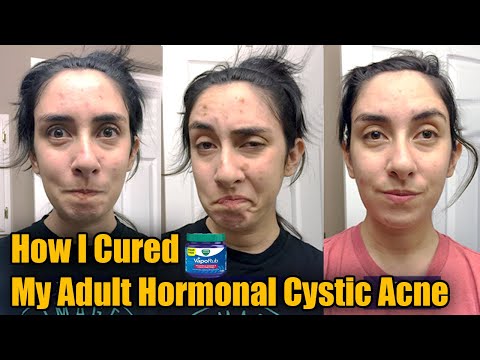 How I Cured My Adult Hormonal Cystic Acne Naturally (no accutane) Acne &amp; Pimples