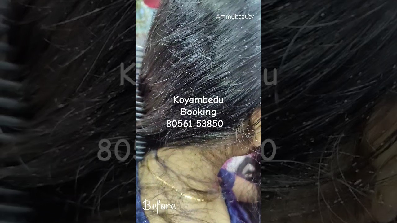 Nits & lice treatment 100 result for one sitting within 2 hr Chennai