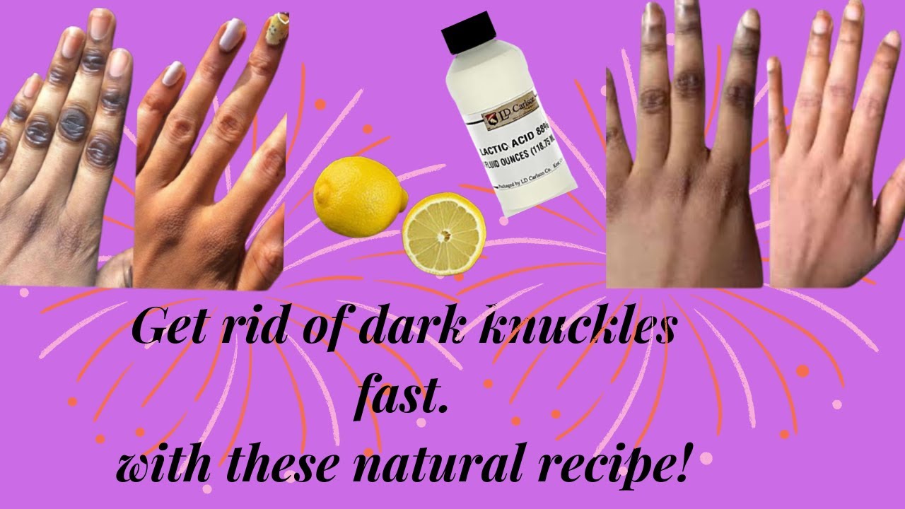 Best natural remedy to eliminate dark knuckles. YouTube