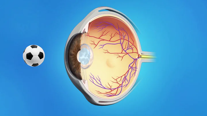 YAG Capsulotomy After Cataract Surgery