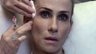 Dermal Fillers For Temples ~ Temple Restoration With Amazing Results