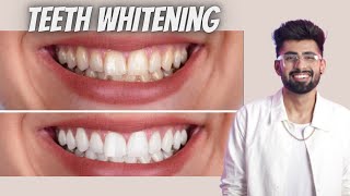 INSTANT TEETH WHITENING AT HOME | Mridul Madhok