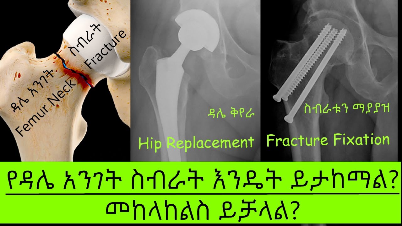 ዳሌ አንገት ስብራት መቸ ይቀየራል | መቸስ ይሰራል | መከላከያ መንገዶቹስ?- ዶ/ር ሳሙኤል ኃይሉ
