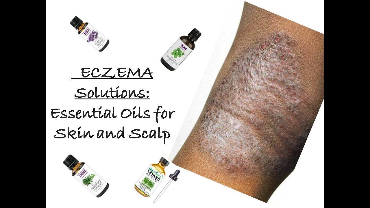 Eczema Solutions Essential oils to treat Eczema YouTube