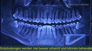 Patienteninformation: Zahnersatz - Implantateinsetzung für einen einzelnen Zahn (Interaktiv)