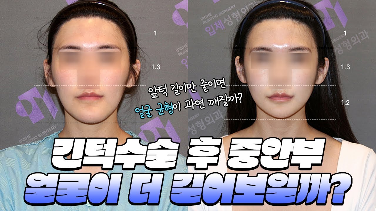 긴얼굴의 경우 윤곽수술을 하면 중안면부 얼굴이 더 길어보일까요?
