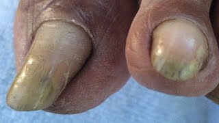 Ingrown toenail removal