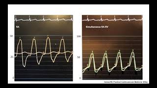 Hemodynamic cases: tricuspid regurgitation, aortic and pulmonic insufficiency - Elias Hanna