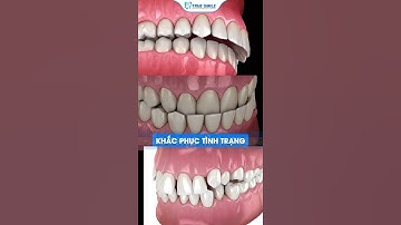 NỀNG RĂNG MẶT LƯỠI