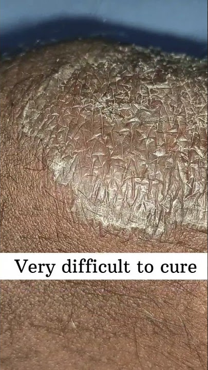 Fungal infection 😱 #skincare #fungalinfection #tinea #eczema