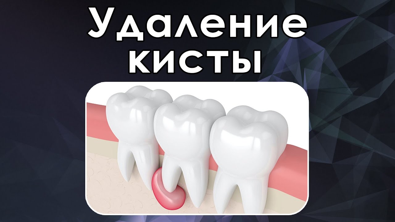 Цистэктомия нижней челюсти - YouTube