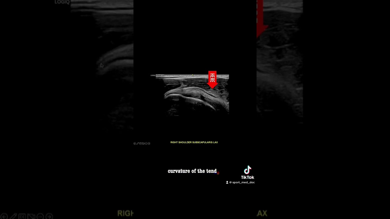 Ultrasound Guided Interventions: Cases (Supraspinatus Tendon Tear 2) 