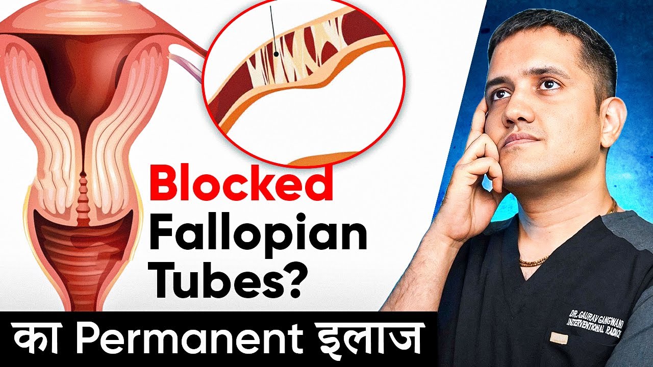 Blocked Fallopian Tube Treatment Without IVF | Fallopian Tube Recanalization | Natural Pregnancy