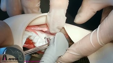 Impacted M3 Surgery hands-on training on 3D printed models