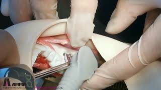Impacted M3 Surgery hands-on training on 3D printed models