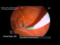 Billroth 2 gastrektomi ercp kolay sfinkterotomi yeni bir teknik easy sphincterotomy billroth ii