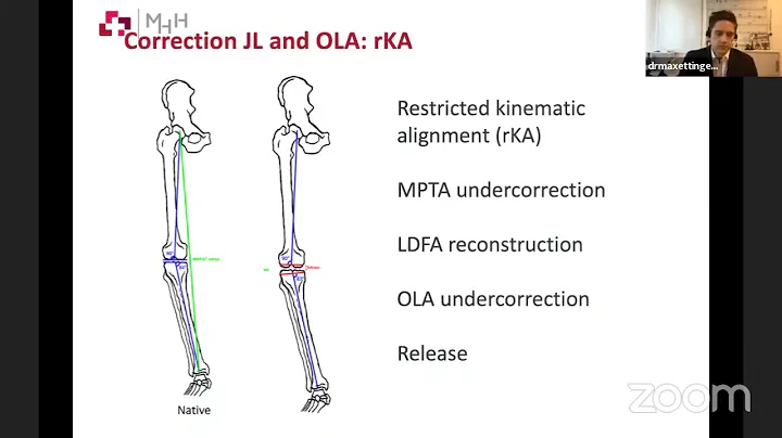 Alignment strategies in Total Knee Replacement