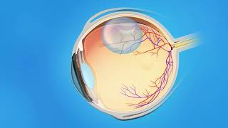 Retina Detached Pneumatic Retinopexy