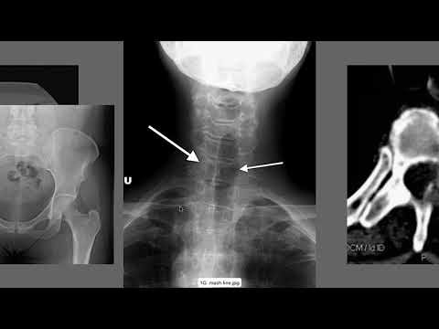 How to Interpret Lumbar X-Ray Images | How to Read Spine X-rays | How to Read Spine Imaging