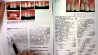 Restoration of Endodontically Treated Teeth | Conservative Dentistry | BDS | 00830 | PPT Only