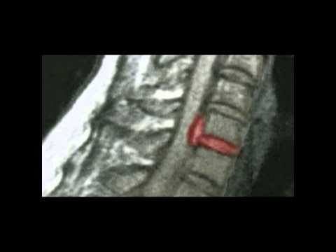Meza   Hernia de disco cervical 119