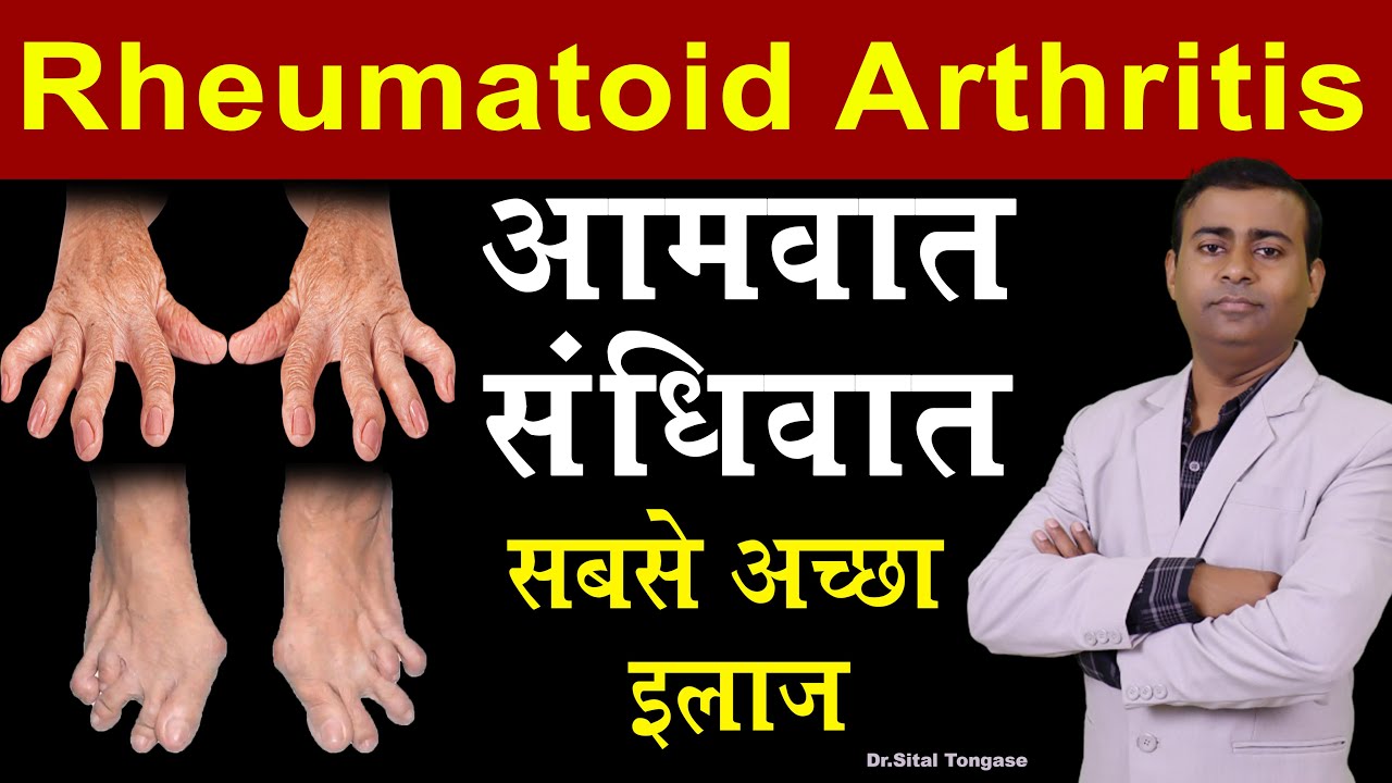 rheumatoid arthritis आमवात, संधिवात सबसे अच्छा इलाज I rheumatoid