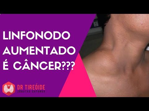 Vídeo: Linfonodos Cervicais Inchados: Causas E Tratamento