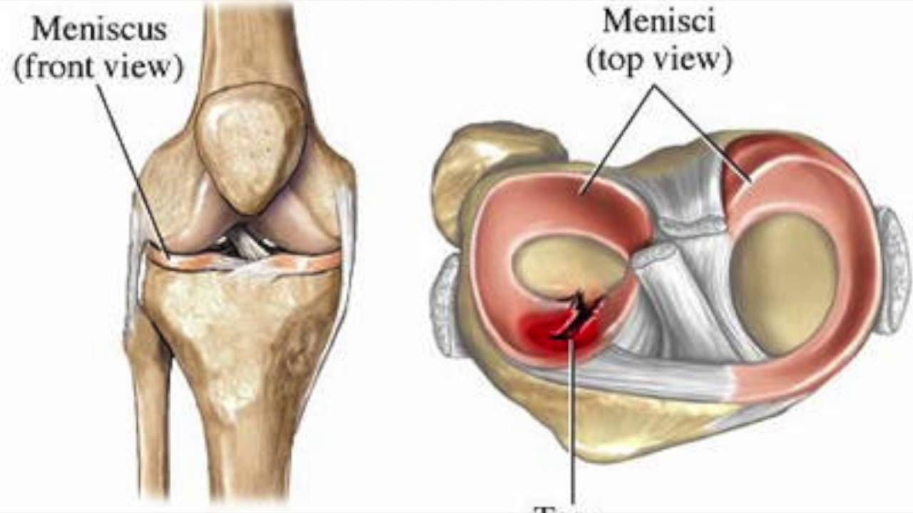 Поврежденный мениск коленного сустава