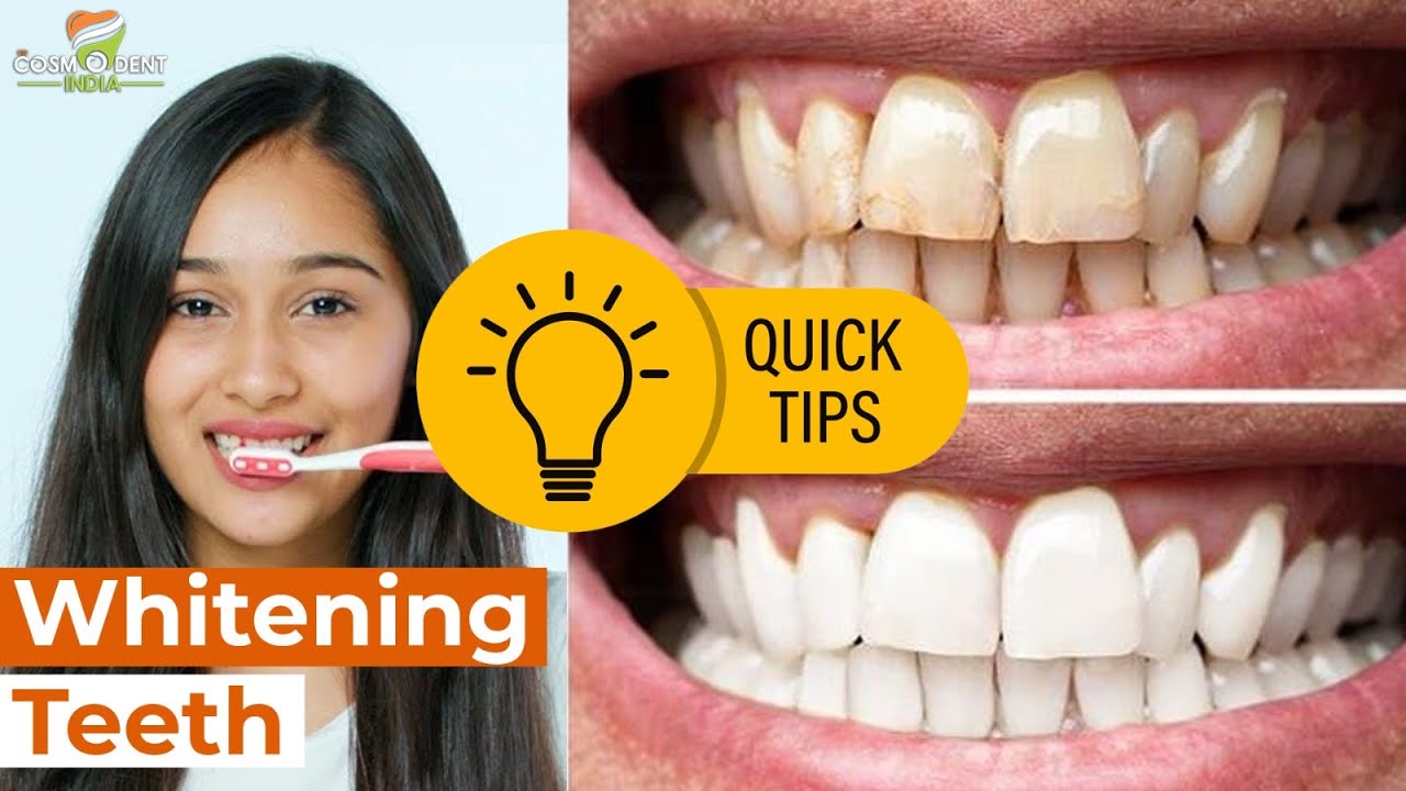 How Can I Make My Teeth White? Teeth Whitening at Dentist Teeth Whitening Treatment