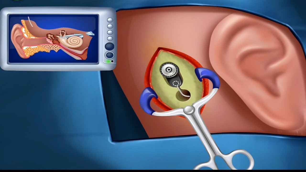 "How a Cochlear Implant Is Placed | Ear Surgery Animation"