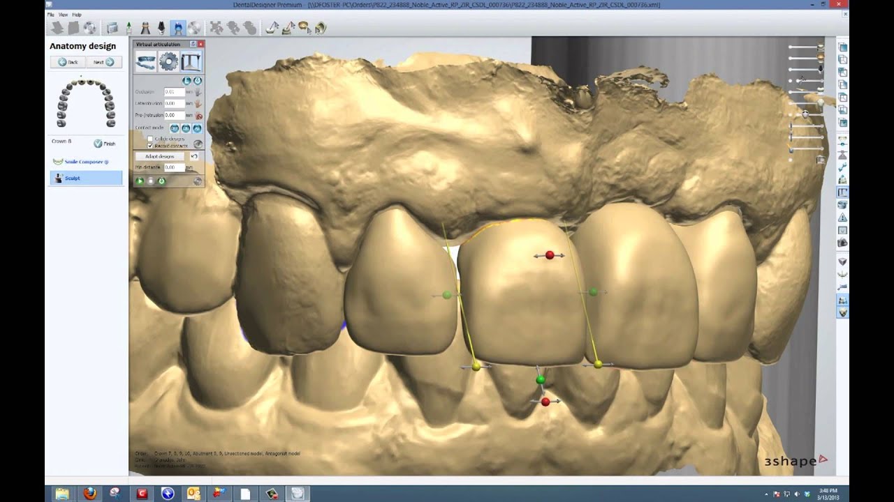 3 shape Trios implant Cornerstone dental labs YouTube