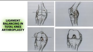 Ligament Balancing in total knee arthroplasty.