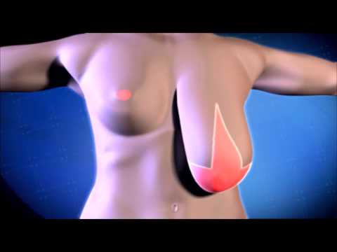 Breast reduction - YouTube
