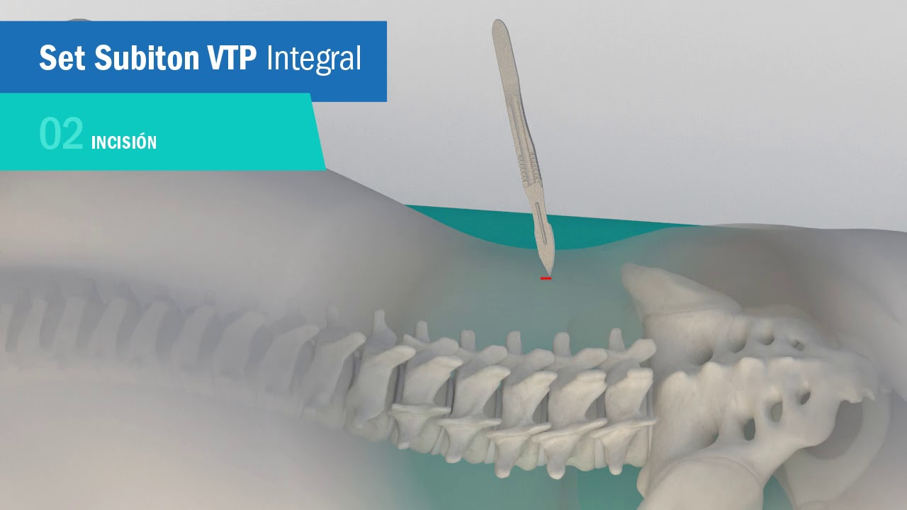 Set Subiton VTP Integral - YouTube