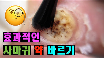 사마귀약 살리실산 사마귀 셀프제거 wart treatment salicylic acid