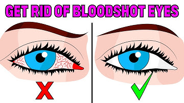 How to Fix Tired & Red Bloodshot Eyes in 5 Easy Steps