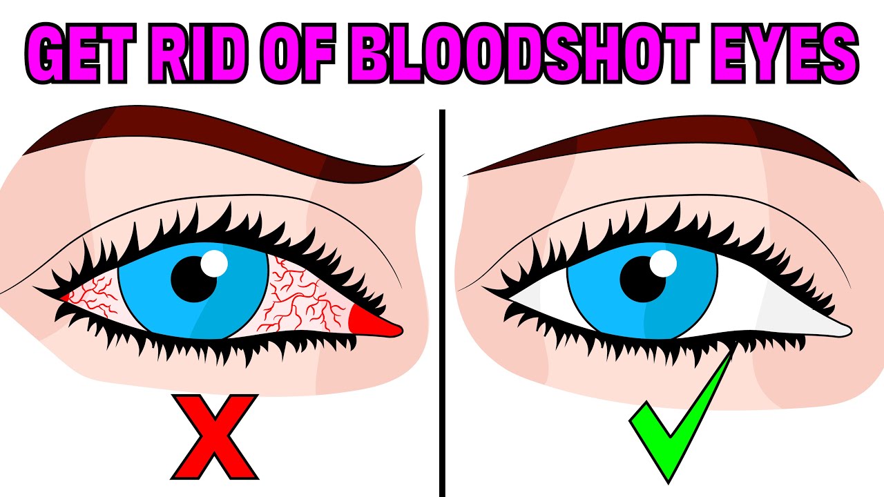 How To Fix Tired \U0026 Red Bloodshot Eyes In 5 Easy Steps
