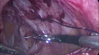 HandX - Ventral Hernia Surgical Video