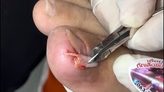 Ep_6565 Big ingrown toenail removal 👣 คุณพี่..ดูนะ 😄 (clip from Thailand)