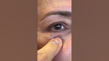 The Problem with Fillers #facecosmeticsurgery #fillerdissolving #fillerinjections