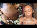 How I Cleared My Skin: Hormonal Acne Journey + Skincare Routine | Just Archived