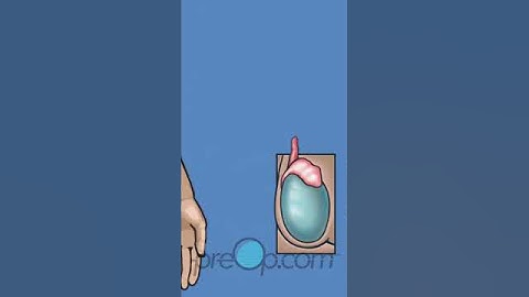 🏥 Non-Scalpel Vasectomy: A Comprehensive Guide 👨‍⚕️🔍