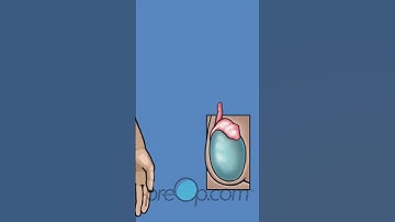 🏥 Non-Scalpel Vasectomy: A Comprehensive Guide 👨‍⚕️🔍