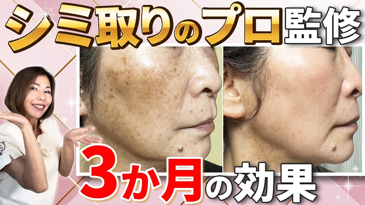 【あれから３年後】驚きの現在の肌公開　失敗か！？ 真っ黒に浮かび上がる「ラスボス現象」が怖すぎたあの日からの57歳シミ取り日記