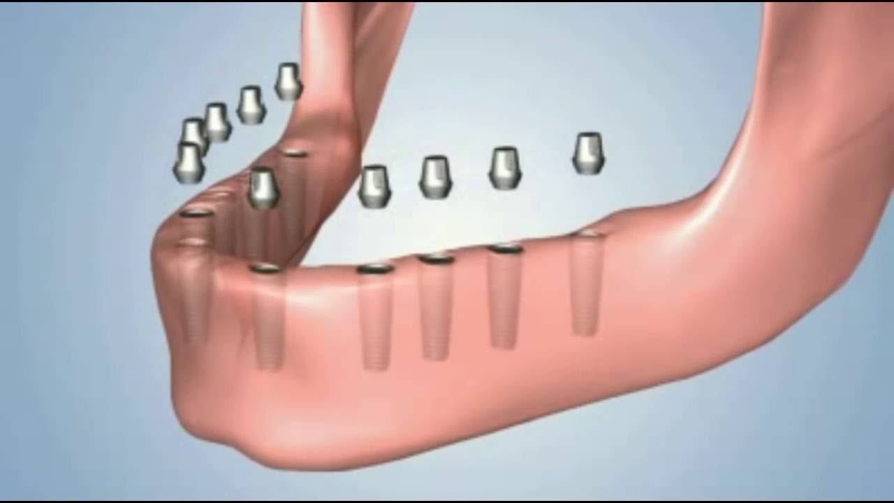 Замяна  на зъбите със зъбни импланти и протези - CityDent