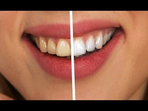Videó: 3 módszer a fogak gyors fehérítésére