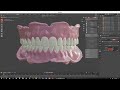 Digital Denture for 3D Printing