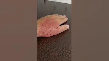 Что делать если тебя укусила крыса.