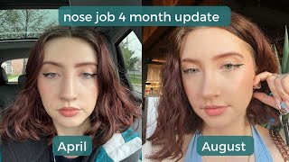 Turkey 4-month rhinoplasty update: Dr. Emre Koçak