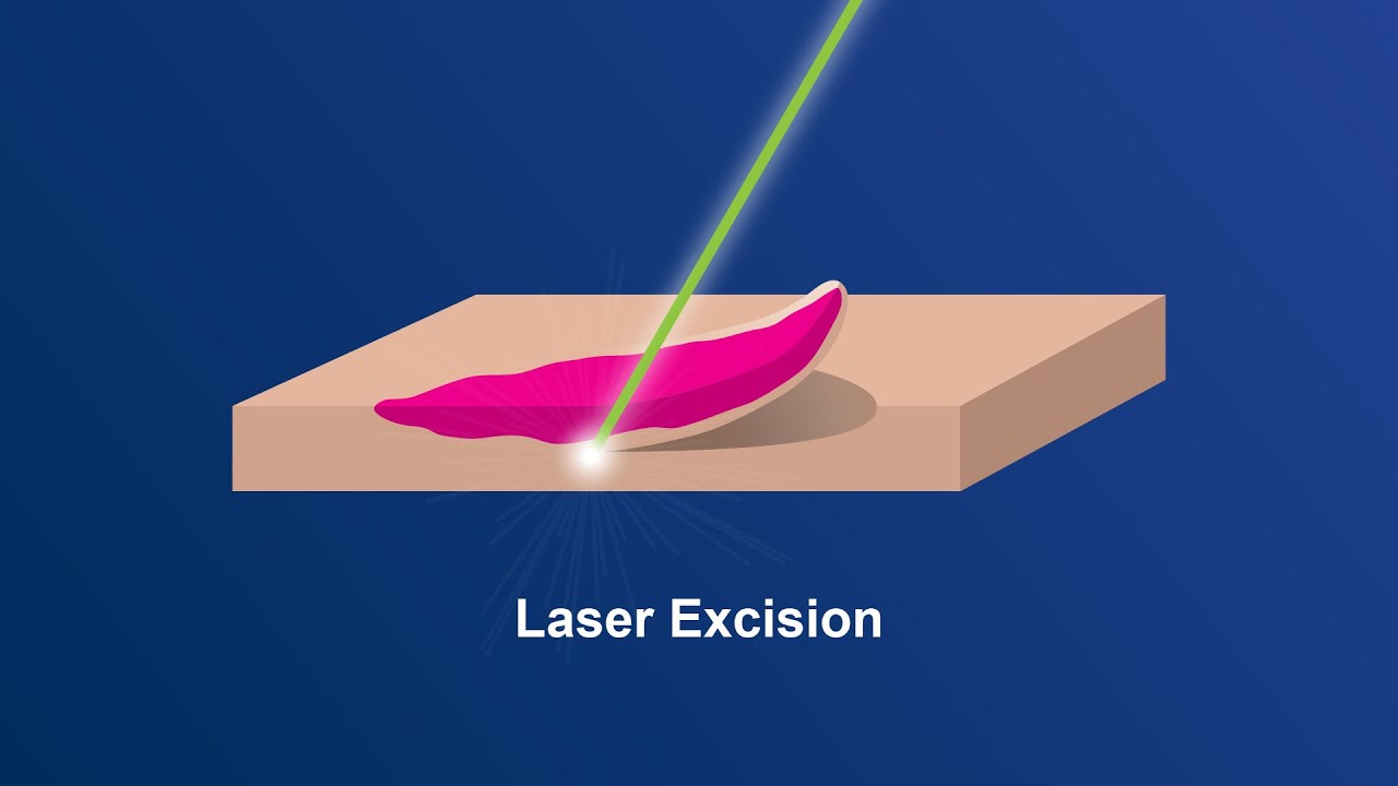 Excision Procedure Ends Years of Endometriosis Pain and Infertility ...